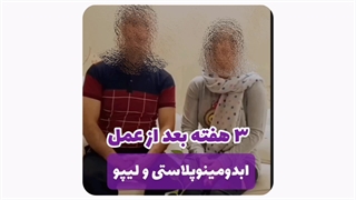 عمل ابدومینوپلاستی و لیپوساکشن در مشهد