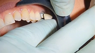 ایمپلنت در تهران