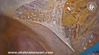 بستن پارگی صفاق در طی ترمیم فتق اینگوینال لاپاراسکوپی با روشی ساده و موثر