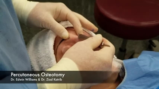 عمل بینی استخوانی و تأثیرات آن بر چهره