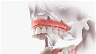 شماتیک بازسازی کامل فک بالا توسط ایمپلنت دندان