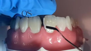 بستن فاصله دندان‌ها با کامپوزیت؛ راهی ساده اما تخصصی