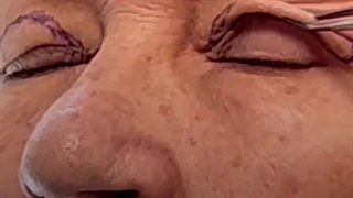 بلفاروپلاستی در کلینیک گونه