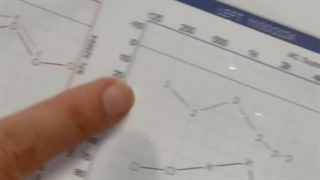 استاپدکتومی و اتواسکلروز دکتر نسرین یزدانی ترمیم ونیر